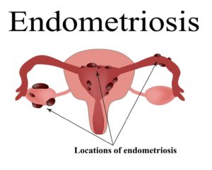 Endometriosis