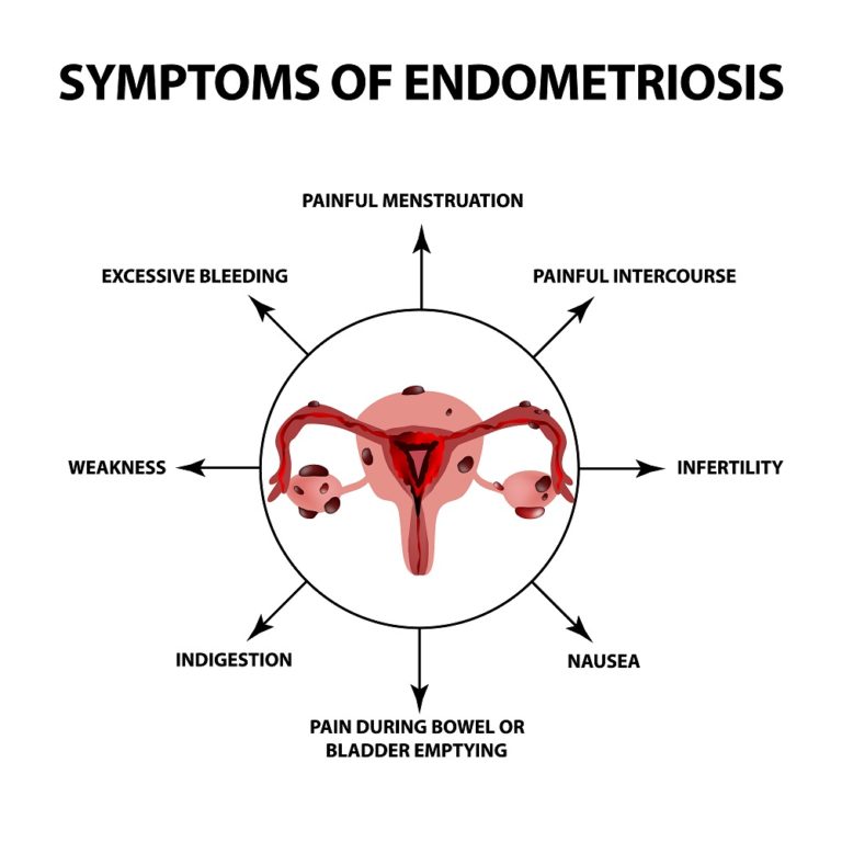 endometriosis bloating treatment