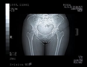 xray of pelvis